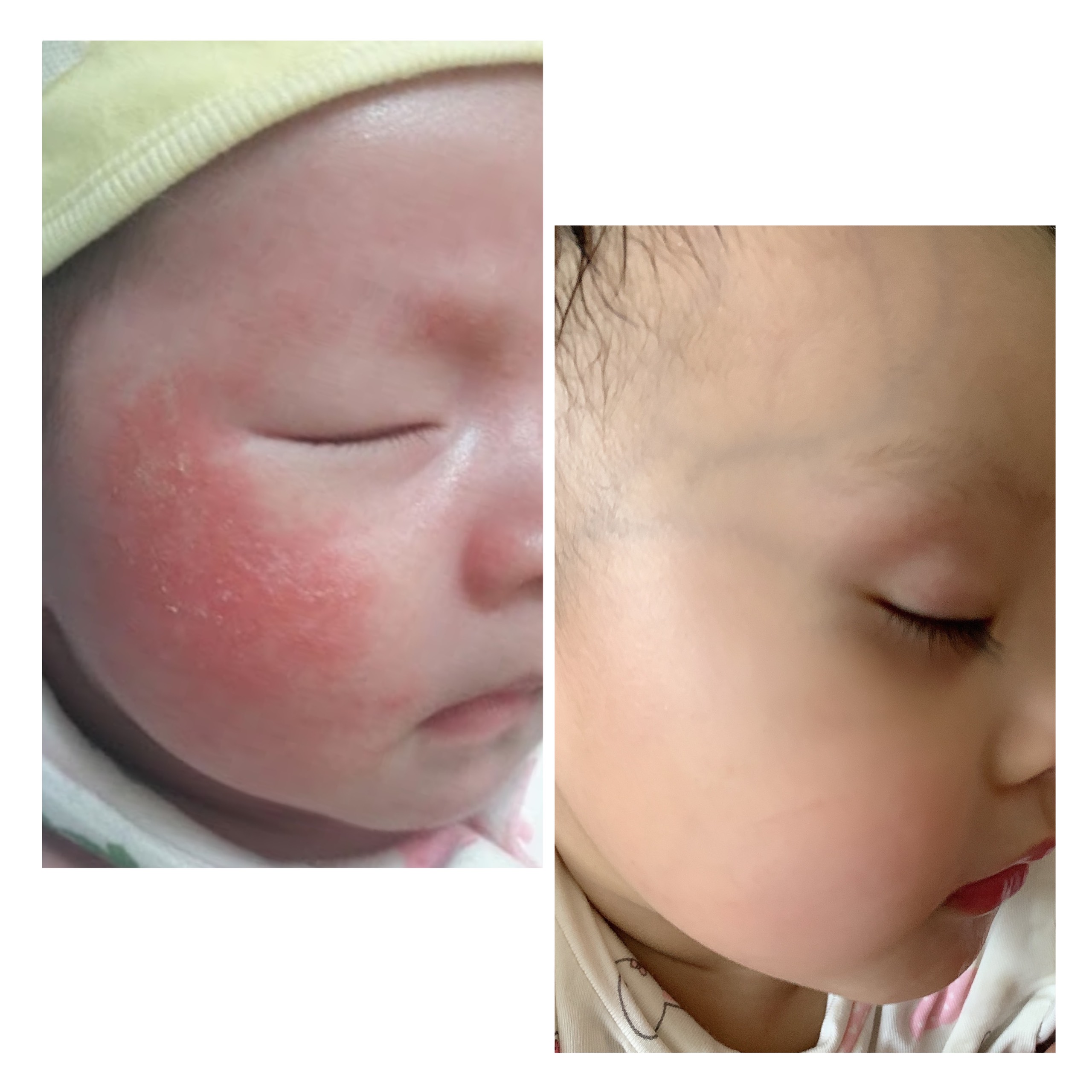 Kết quả giảm rôm sảy mẩn đỏ trên da bé